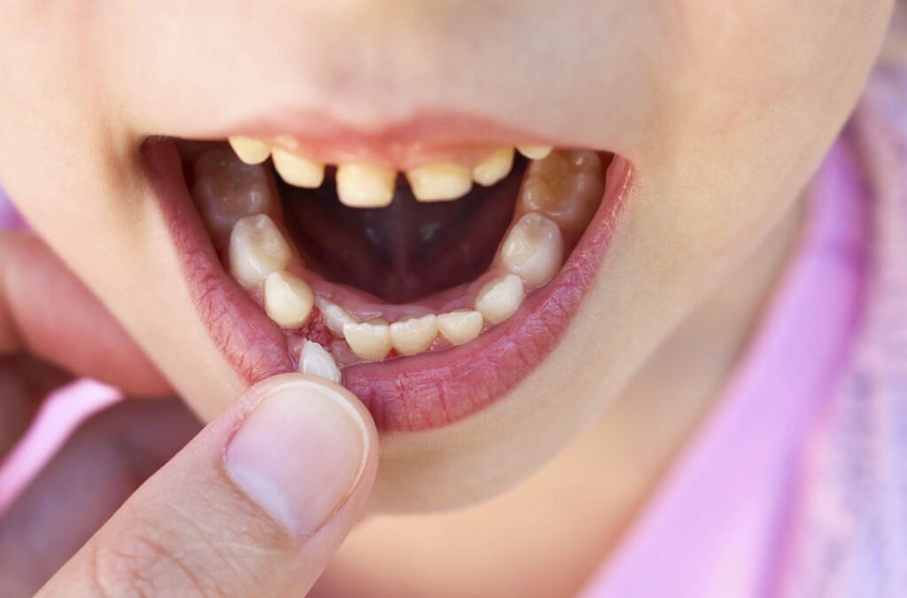Qué significa soñar que se te caen los dientes y su interpretación 1 diente cayendo sobre una almohada